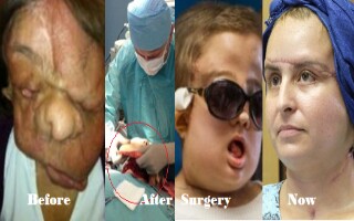 Unbelievable: Woman Who Was Severely Disfigured By Facial Tumour Shows Her New Face After Extensive Facial Transplant